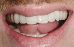 Figure 4 Length was added to the anterior bridges as a mock-up during the initial consultation.