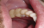 Figure 5 Fixed bonding was placed on the posteriors to increase vertical dimension and reduce occlusal irregularities.