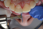 Figure 4 Further refinement of the mesial–labial line angle to further refine embrasure space and create symmetry of both centrals with a medium-grit product (FlexiDisc) is preferred.