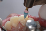 Figure 7 Polishing the lingual surface with diamond polishers (Cosmedent’s nanohybrid composite polishers).