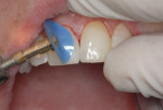 Figure 2 A four-disc grit sequence—from coarse to superfine—can be used to achieve a high polish and invisibly blend composite into the tooth structure. Note the high flex and resilience of the discs (FlexiDisc System by Cosmedent).
