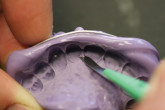 Predictable Implant Solutions for the Edentulous Patient Webinar Thumbnail