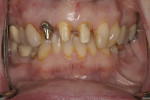 Figure 6  Refinement of teeth preparations after removal of previous metal-ceramic crowns.