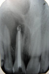 Figure 6  Radiograph showing obturated upper right central incisor.