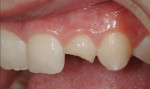 Figure 4 The maxillary lateral incisor is the most common anterior esthetic restoration to fracture when the occlusal scheme is not perfected.