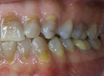 Figure 5 Forces that produce wear facets in natural dentition will result in fractured porcelain. A night guard should be fabricated if it is determined that the parafunction occurs while the patient is asleep.