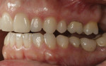 Figure 3 With any protrusive movement of the mandible, the goal is immediate posterior disclusion.