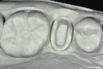 Figure 7 Stone model of the prepared tooth ready for digital scanning.