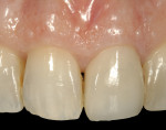 Figure 5  Intraoral pretreatment condition of tooth No. 9, which had a horizontal-oblique fracture of the tooth toward the palatal aspect.