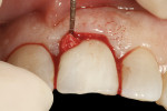 Figure 22  The provisional restoration was re-placed onto the implant, acting as a “prosthetic socket seal,” and tightened with finger pressure using a handheld screwdriver. A periodontal probe tip was used to remove excess bone graft material to
