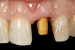 Figure 30  The gold-plated abutment was seated intraorally, ready for cementation of the definitive restoration. Note that gold plating an alloy abutment imparts a warm hue to the gingival tissues.