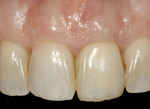 Figure 33  The definitive metal-ceramic restoration seated intraorally, showing good color matching and periodontal health. No xenograft particles were visible through the peri-implant soft tissues.