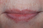 Figure 5  The patient’s lip proportion was checked against the model.