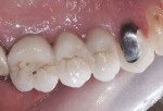 Figure 12 An occlusal view of the completed restorations. Note the normal sized occlusal tables of the implant restorations.