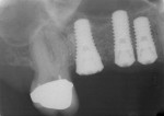Figure 13. A radiograph taken 6 months post therapy demonstrated complete bone fill around the implants.