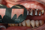 Figure 14  After trying in the bridge, the tissue color was checked using the Chairside Shade Guide. The color was determined to be between light pink and light coral. The technician mixed the gingiva color with translucency to achieve the correct ef