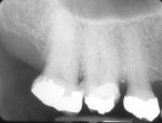 Figure 15 A patient presented with a vertically fractured first molar. Note the periapical lesion that was present.