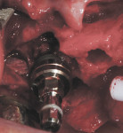Figure 10 A buccal view demonstrated the compromised buccal alveolar ridge around the
implant. Note the ideal positioning of the implant.