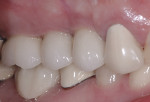 Figure 11 A buccal view of the completed restorations of the implants in the first molar and first and second bicuspid positions.