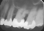Figure 1 A patient presented with a buccal fistula and a hopeless prognosis for a maxillary first molar. The remaining bone protecting the mesial furcation of the second molar was at risk.