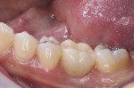 Figure 3: Buccal view of final restoration at delivery.