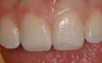 Figure 10 An intraoral mock-up was created.