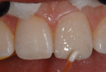 Figure 15 A white tint was applied to the dentin replacement layer.