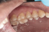 Fig 11. Pretreatment radiograph demonstrating bone loss on the mandibular right first molar.