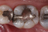 Fig 19. Comparison of a dental implant before (left) and after (right) implantoplasty. Being able to remove the crown and place a healing abutment allowed improved access to achieve a machine-like surface to the base of the peri-implantitis defect.