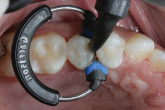 Fixed and Removable Solutions for Edentulous Patients Webinar Thumbnail