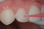 Figure 17 Smooth surface sealant applied to lateral incisors and lingual surfaces of all four incisors.