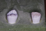 Figure 3 Lemon juice–soaked teeth with severe demineralization.