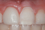 Figure 16 Right central incisor veneer completed.