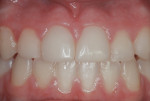 Figure 19 Two years postoperatively, before dental prophylaxis or renewed surface polishing.