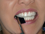 Figure 16  Occlusal adjustments are made until there is a simultaneous point of contact on all teeth.