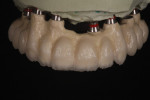 Figure 8. The second bake used dentin and a window frame of enamel porcelain with a
small amount of Flo Dentin for mamelons.