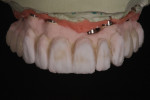 Figure 9. Third build was an enamel overlay of the tooth forms and a base coat of tissue porcelain.