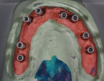 Figure 1. Cases involving full-arch
screw-retained splints are among the most challenging in the dental laboratory.