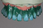 Figure 2. Preformed pontics were attached to the abutments, and then wax was taken straight down to the tissue.