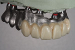 Figure 5. A wax-up was done on the anterior so the doctor could confirm the incisal edge position mid-line and basic esthetics.
