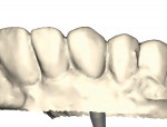 Figure 3. An implant abutment is digitally designed in multiple steps.