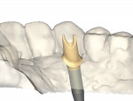 Figure 4. An implant abutment is digitally designed in multiple steps.