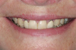 Figure 1  The patientas preoperative smile. Notice the disharmony in the incisal edge positions of the maxillary anterior teeth.