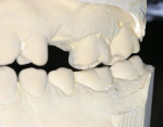 Figure 4  When placed in centric relation, the  patientas only occlusal contact involved teeth Nos. 15 and 18.