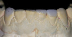 Figure 7  The diagnostic wax-up for the lower anterior teeth required only replacing tooth that had been lost to wear. Harmony of the posterior and anterior occlusal plane was re-established.