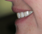 Figure 9  This photograph of the provisional restorations highlights the proper placement of the maxillary horizontal incisal edge position in relation to the vermillion border of the lower lip. Note that the facial plane of the incisors has a defini