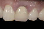 Figure 1  Image of a clinical situation of overcontour with the associated gingival inflammation.