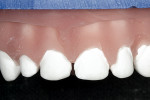Figure 3  A soft tissue cast with removable dies using the pink PVS impression material for the gingiva.
