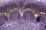 Figure 5  The marginal gingiva is blocked out with wax to support this area so that it does not tear on stone removal.