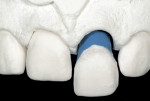 Figure 16  Demonstration of the resolvability of the dies with the intact gingival elements.